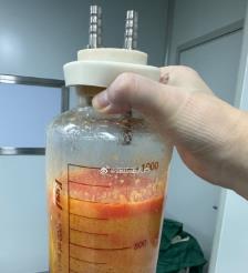博白水动力吸脂手术要做多久？